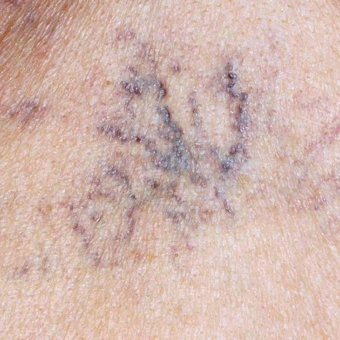 Emergence of spots on the skin