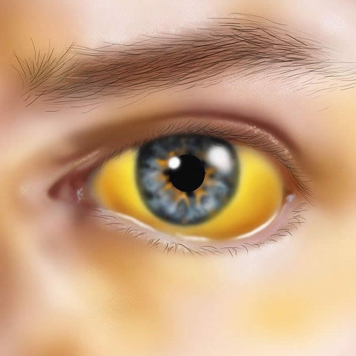 Jaundice or Yellowy eyes & Skin