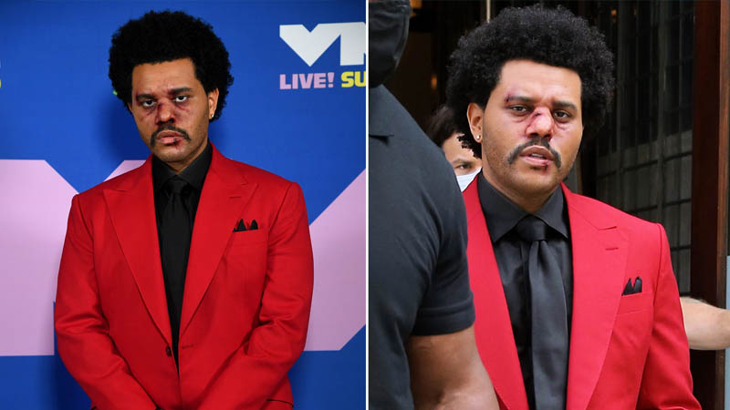  Why did The Weeknd arrive at the VMAs with blood and bruises all over his face?