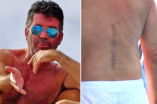  Simon Cowell shows off huge back scar on a yacht in Barbados after surgery and horrific bike accident