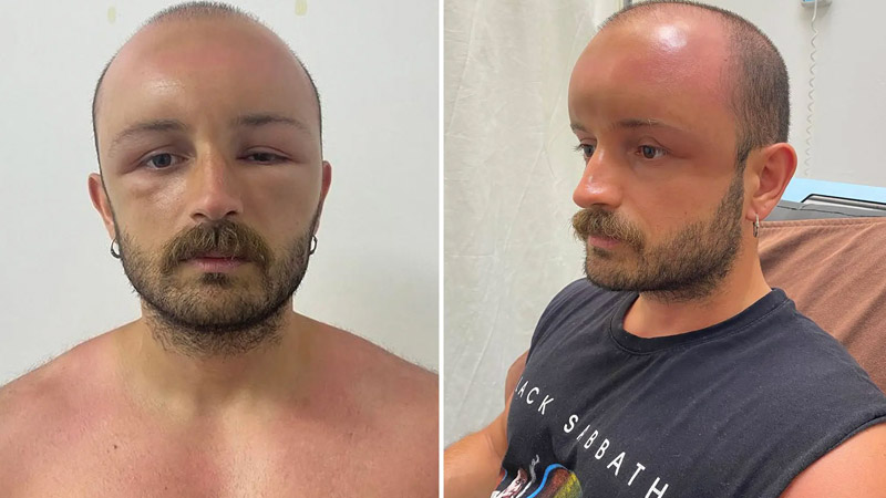  Man develops swollen head after spending the day at the beach: Doctors Socked