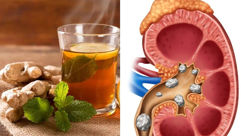  A secret Ginger tea recipe breaks down kidney stones, cleanses the liver, and kills cancer cells