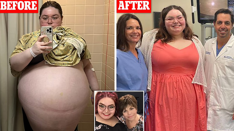  Florida Woman had 100-lb ovarian cyst surgically removed, allowing her to “feel like a person again”