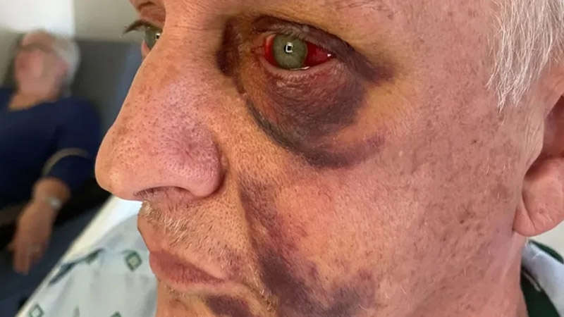  Florida Gay Man Brutally Attacked by Two Men Yelling Antigay Slurs