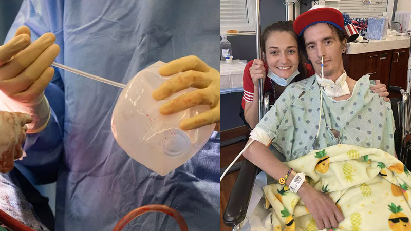  Doctors Use Breast Implants During Lung Transplant To Save Life of Man Who Vaped for Years