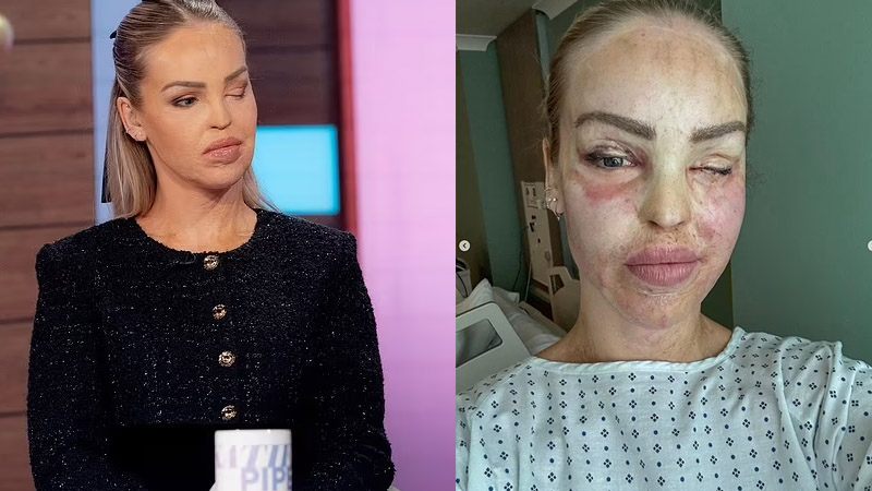  ‘Loose Women’ Katie Piper shares health update following risk of ‘losing left eye’