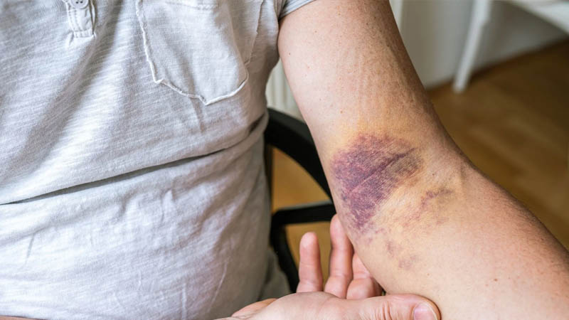 unexplained bruise