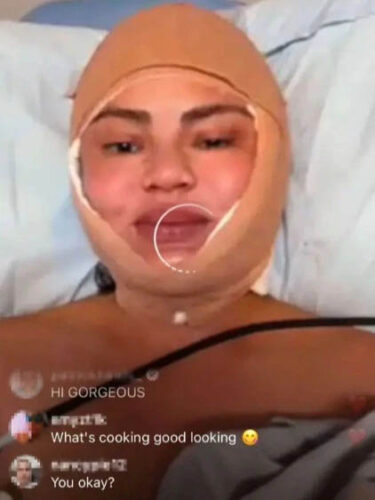 Chrissy Teigen Hairline Surgery