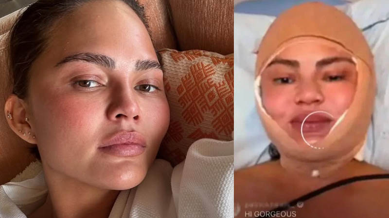 Chrissy Teigen drastic cosmetic surgery