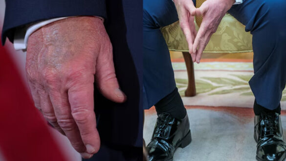President Trump’s swollenaAnkles andbBruised hand spark new health rumors (Photo Credit: Getty Images)