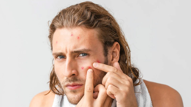 Pimples